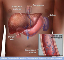 What are symptoms of an enlarged liver?