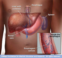 Symptoms and Causes of Enlarged Spleen (Splenomegaly)