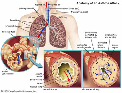 Inhaled corticosteroids for acute asthma